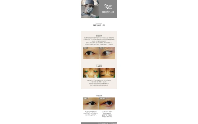 Lateral Canthoplasty Reversal Case 03