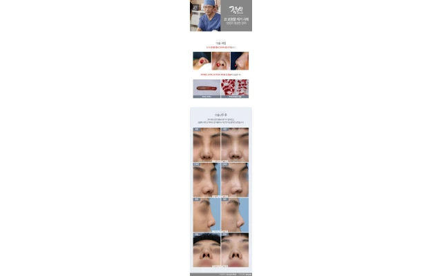 Nasal Implant Removal Case 01: Resolving an Infection