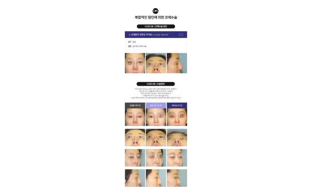 Revision Rhinoplasty 08) Infection and Silicone Extrusion