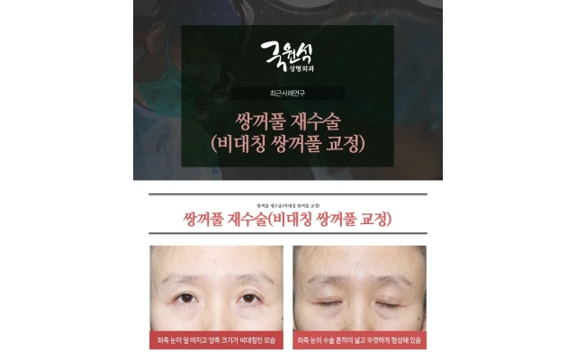 Revision Double Eyelid Surgery (Asymmetric Crease Correction) Case