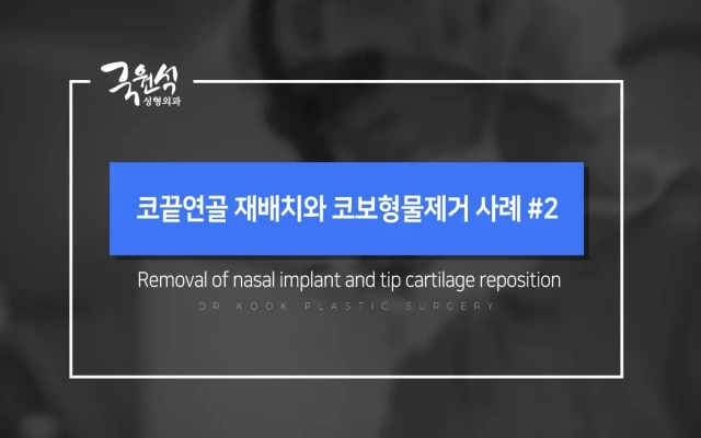Tip Cartilage Repositioning and Nasal Implant Removal: Case #2