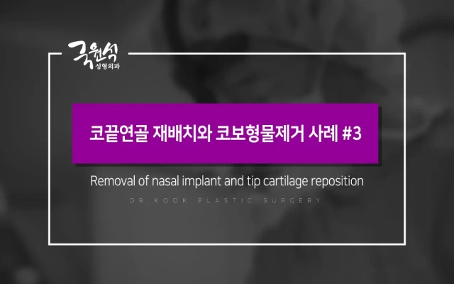 Tip Cartilage Repositioning and Nasal Implant Removal: Case #3
