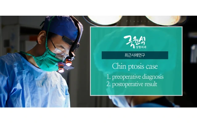 Chin ptosis case / ptotic chin / witch’s chin