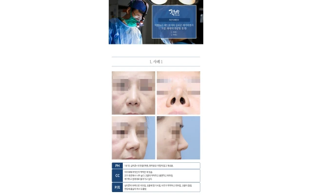 악명 높은 메드포어&실리콘 제거하면서 코끝재배치(개방형절개)