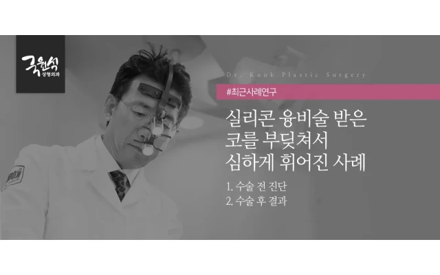 실리콘 융비술 받은 코를 부딪혀서 심하게 휘어진 사례(휜코/휘어진코교정)