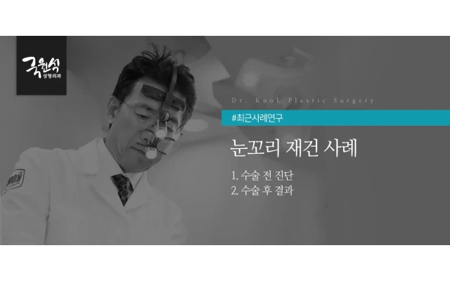 눈꼬리 재건 사례 (밑트임 수술 후 부작용)