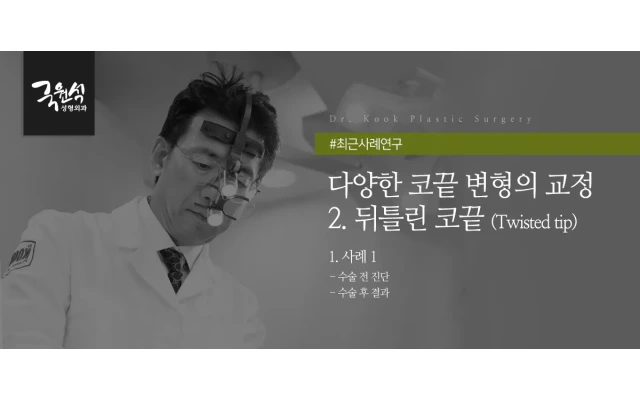 다양한 코끝 변형의 교정 #2. 뒤틀린 코끝 (Twisted tip)#코끝수술 #코끝재수술