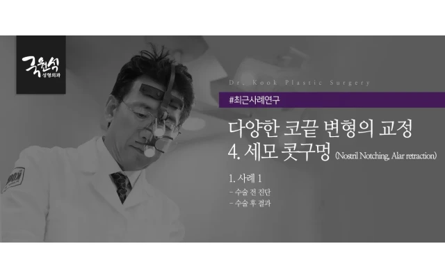 다양한 코끝 변형의 교정 #4 세모 콧구멍(코재수술)