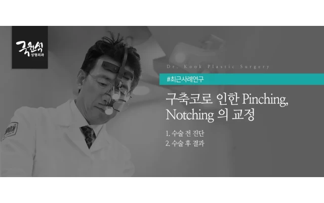 구축코로 인한 Pinching,Notching 의 교정 (구축코교정, 코재수술)