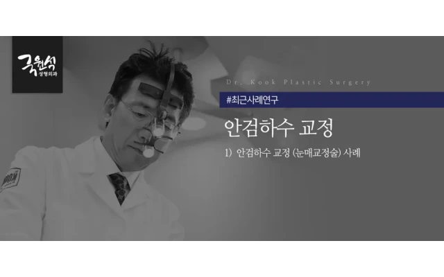 피곤해 보이는 안검하수 교정, 눈매교정술 사례
